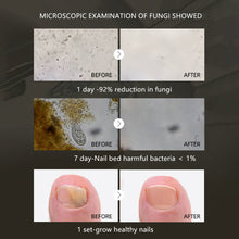 Load image into Gallery viewer, 20ml Nail Fungal Treatment Oil Feet Care Repair Essence Toe Nail Fungus Removal Gel Anti Infection Remedy Cream