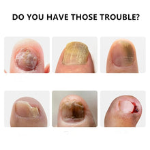 Load image into Gallery viewer, 20ml Nail Fungal Treatment Oil Feet Care Repair Essence Toe Nail Fungus Removal Gel Anti Infection Remedy Cream