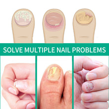 Load image into Gallery viewer, Nail Repair Fungal Relief Herbal Essence Repair Nourish & Protect Grey Nail Repair Nail Fungus Ointmen