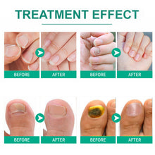 Load image into Gallery viewer, Nail Repair Fungal Relief Herbal Essence Repair Nourish & Protect Grey Nail Repair Nail Fungus Ointmen