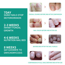 Load image into Gallery viewer, Nail Repair Fungal Relief Herbal Essence Repair Nourish & Protect Grey Nail Repair Nail Fungus Ointmen