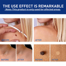 Load image into Gallery viewer, Wart Clamp Painless Warts Removal Clip Removing Warts Filamentous Warts Nevi Meatballs Skin Repair Skin Care