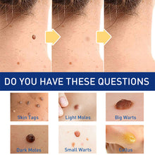 Load image into Gallery viewer, Wart Clamp Painless Warts Removal Clip Removing Warts Filamentous Warts Nevi Meatballs Skin Repair Skin Care