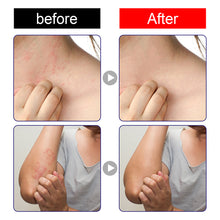 Load image into Gallery viewer, Skin Antibacterial Cream Mosquito Bite Skin Pruritus Antipruritus Cream Plant Extracts External Antibacterial Cream Skin Care