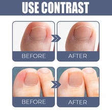 Load image into Gallery viewer, Removal Paronychia Oil Soften Toenails Relieve Swelling Pain Nail Groove Relief Oil Disinfect Repair Toenails