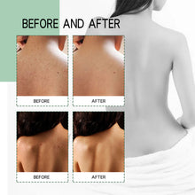 Load image into Gallery viewer, Back Acne Treatment Spray Repair Back Shoulder Acne Clean Skin Exfoliate Fade Acne Marks Skin Care Spray