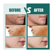 Load image into Gallery viewer, Star Shaped Acne Patches Repair Acne Fade Spots Cover Acne Marks Facial Acne Repair Patches Skin Care