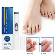 Load image into Gallery viewer, Nail Blue Light Laser Pen Onychomycosis Repair Laser Pen Restoring Nail Health Removing Odor Nail Care Tool