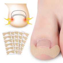 Load image into Gallery viewer, Toenail Correction Patches Ingrown Toenail Corrector Stickers Paronychia Inlaid Nail Restoration Patches Nail Tools
