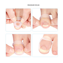Load image into Gallery viewer, Ingrown Toenail Corrector Ring Elastic Washable Physically Fixed Toenail Silicone Ring Paronychia Restoration Tool