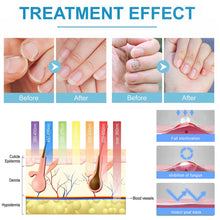 Load image into Gallery viewer, Gray Nail Care Device Gray Nail Fungus Cleaning and Care Device Mini Onychomycosis Treatment Fungal Nail Laser Device