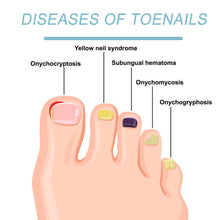 Load image into Gallery viewer, Gray Nail Care Device Gray Nail Fungus Cleaning and Care Device Mini Onychomycosis Treatment Fungal Nail Laser Device