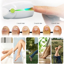 Load image into Gallery viewer, Blue Light Pulse Nails Feet Nail Fungus Laser Nail Therapy Device Foot Care Removal Device Fingernail Therapy Onychomycosis Treatment Device