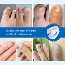 Load image into Gallery viewer, Portable Onychomycosis Auxiliary Tool UV Nail Phototherapy Lamp Cleaning Lamp Onychomycosis Fungus Lamp