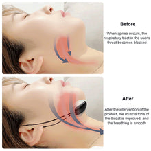 Load image into Gallery viewer, Portable EMS Smart Anti Snoring Device Noise Reduction Muscle Stimulator Comfortable Sleep Well Health Care