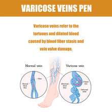 Load image into Gallery viewer, Varicose Vens Pen Repair Vasculitis Phlebitis Soothe Skin Relieve Varicose Feet Blood Vessel Blockage Body Health Care