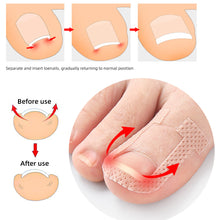 Load image into Gallery viewer, U-shaped Nail Stickers Paronychia Ingrown Toenail Correction Patches Elastic Stretching Onychocryptosis Restoration Patches