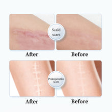 Load image into Gallery viewer, 1 Roll 40MM*1.5M Gel Scar Patch Inhibit Scar Hyperplasia TPU Waterproof Stretch Mark Care Strips