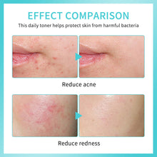 Load image into Gallery viewer, Face First Aid Spray Hypochlorous Acid Skin Spray Soothing Calming Irritated Skin Reducing Acne Redness Skin Care Spray