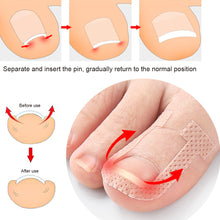 Load image into Gallery viewer, 10sheets Nail Correction Stickers Ingrown Toenail Corrector Patches Treatment Recover Corrector Pedicure Care Tool