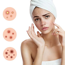 Load image into Gallery viewer, 200Pcs Repair Acne Patches Fade Blemishes Pimple Marks Closed Acne Blemishes Hydrocolloid Star Heart Shaped Cover Acne Pimple Patch