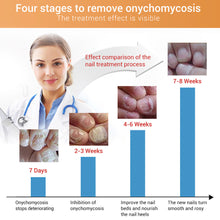 Load image into Gallery viewer, Nail Fungus Anti Infection Feet Care Essence Nails Foot Repair Toe Nail Fungal Treatment Removal Gel Paronychia Onychomycosis