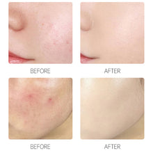 Load image into Gallery viewer, 72pcs/bag Invisible Acne Pimple Patch Mask Skincare Blemish Spot Concealer Remover Pimple Patches Stickers Masks Beauty Health