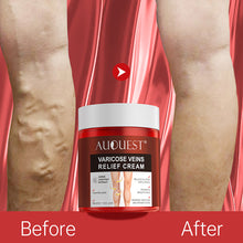 Load image into Gallery viewer, Varicose Veins Treatment Cream Relieve Tired Legs Dilated Phlebitis Spider Pain Relief Ointment Body Care Varicose Veins Cream