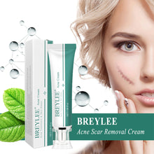 Load image into Gallery viewer, Scar Remover Cream Stretch Acne Treatment Scars Removal Skin Repair Cream Whitening Dark Spot Remover Cream Face Skin Care