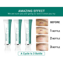 Load image into Gallery viewer, Scar Remover Cream Stretch Acne Treatment Scars Removal Skin Repair Cream Whitening Dark Spot Remover Cream Face Skin Care
