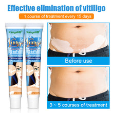 Load image into Gallery viewer, Herbal Extract Vitiligo Ointment Remove Ringworm White Spot Removal Skin White Spot Leukoplakia Disease Treatment Cream