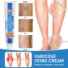 Load image into Gallery viewer, Herbal Varicose Veins Treatment Cream Relieve Tired Legs Dilated Vasculitis Phlebitis Spider Pain Relief Ointment Body Care
