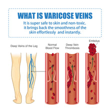 Load image into Gallery viewer, Herbal Varicose Veins Treatment Cream Relieve Tired Legs Dilated Vasculitis Phlebitis Spider Pain Relief Ointment Body Care