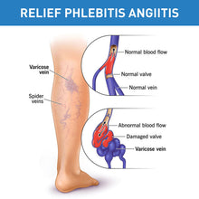 Load image into Gallery viewer, Herbal Varicose Veins Treatment Cream Relieve Tired Legs Dilated Vasculitis Phlebitis Spider Pain Relief Ointment Body Care