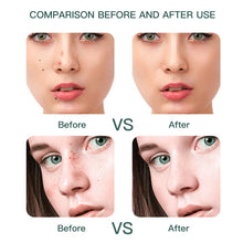Load image into Gallery viewer, Electric Skin Tag Remover Wart Berrugas Eliminator LCD Plasma Pen Papillomas Laser Removal Freckle Dark Spot Mole Cauterizer Kit