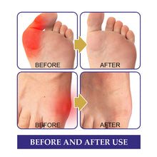 Load image into Gallery viewer, 5pcs/box Anti-bunion Patches Correct Foot Thumb Eversion Relieve Swelling Pain Foot Care Patches Health Care