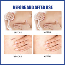 Load image into Gallery viewer, 4 Pairs Silicone Breast Scar Sheets Sticker Lighten Flatten Scar Removal Stickers Acne Treatment Scars Gel Surgical Scar Patches