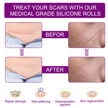 Load image into Gallery viewer, Silicone Women Invisible Efficient Surgery Scar Removal Gel Therapy Patches Acne Trauma Scald Scar Skin Repair Caesarean Section Treatment