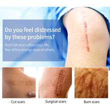 Load image into Gallery viewer, Scar Removal Cream Acne Spots Remove Burn Surgical Scar Repair Cream Smoothing Cream Treatment Hyperplastic Scar Repair Gel