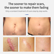 Load image into Gallery viewer, Scar Removal Cream Acne Spots Remove Burn Surgical Scar Repair Cream Smoothing Cream Treatment Hyperplastic Scar Repair Gel