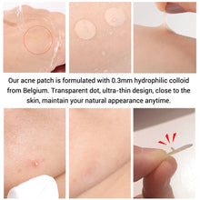Load image into Gallery viewer, Mini Acne Pimple Patch Invisible Acne Removal Patches Acne Treatment Acne Master Pimple Remover Daily / Night Stickers