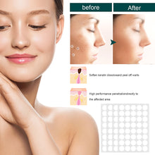 Load image into Gallery viewer, 120/240Pcs Skin Tag Remover Patches Wart Treatment Stickers Treatments Hydrocolloid Gel Acne Warts Invisible Skin Care