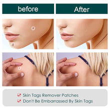 Load image into Gallery viewer, 120/240Pcs Skin Tag Remover Patches Wart Treatment Stickers Treatments Hydrocolloid Gel Acne Warts Invisible Skin Care