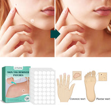 Load image into Gallery viewer, 120/240Pcs Skin Tag Remover Patches Wart Treatment Stickers Treatments Hydrocolloid Gel Acne Warts Invisible Skin Care
