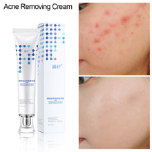 Load image into Gallery viewer, Acne Removal Face Cream Anti-Acne Gel Treatment Acne Scar Oil Control Eliminate Pimples Whitening Moisturizing Face Care