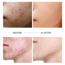 Load image into Gallery viewer, Acne Removal Face Cream Anti-Acne Gel Treatment Acne Scar Oil Control Eliminate Pimples Whitening Moisturizing Face Care