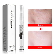 Load image into Gallery viewer, Freckles Remove Cream Melasma Remover Dark Spot Lightening Removal Moisturizing Brighten Freckle Remove Face Skin Care Cream