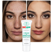 Load image into Gallery viewer, Herbal Acne Spots Oil Control Gel Moisturizing Acne Removal Cream Remove Pimple Acne Scar Cream Whitening Smooth Skin Care