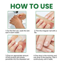 Load image into Gallery viewer, 20ml Onychomycosis Liquid Onychomycosis Care Repair Liquid Nail Feet Onychomycosis Liquid Nail Care Liquid Health Care