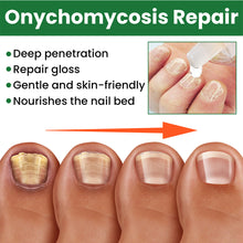 Load image into Gallery viewer, 20ml Onychomycosis Liquid Onychomycosis Care Repair Liquid Nail Feet Onychomycosis Liquid Nail Care Liquid Health Care
